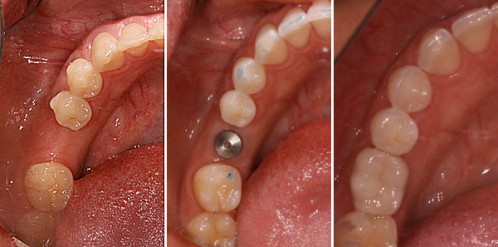 Chi phí trồng răng giả implant bao nhiêu là chuẩn nhất?
