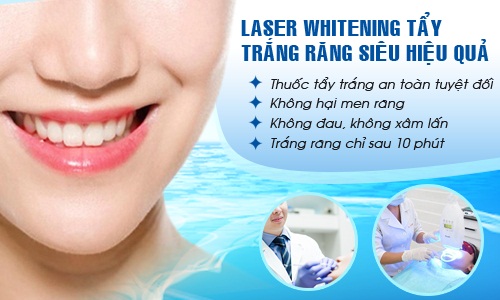 Tẩy trắng răng bao nhiêu tiền với phương pháp Laser Whitening