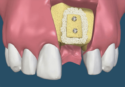 Trường hợp nào phải ghép xương trồng răng Implant 