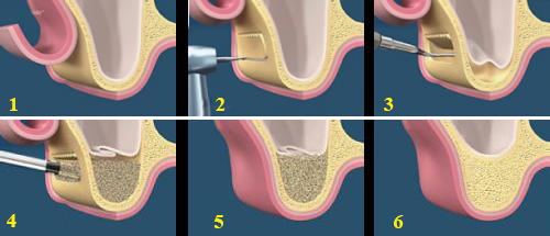 Quy trình ghép xương trồng răng implant 