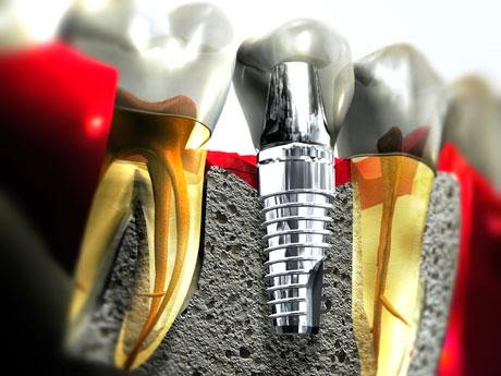 Nên sử dụng loại chân răng giả Implant nào tốt nhất hiện nay? - 1