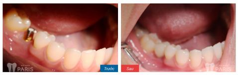 Bật mí: Trồng răng cấm nên dùng loại răng sứ nào? 3