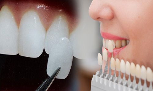 cách làm răng nanh dài ra tự nhiên