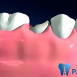 Bị gãy răng hàm – Nguyên nhân, ảnh hưởng và cách khắc phục