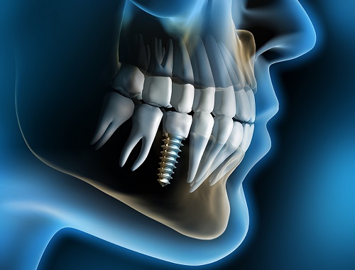 Làm sao để biết Implant là gì? Với cả răng implant có bền không? 1