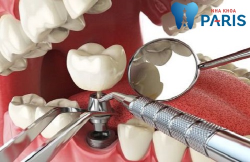 3 Nguyên nhân răng Implant bị lung lay và biện pháp khắc phục 3