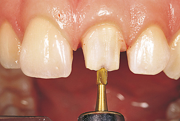 Mài răng cửa có hại không? Cách chăm sóc răng sau khi mài răng 1