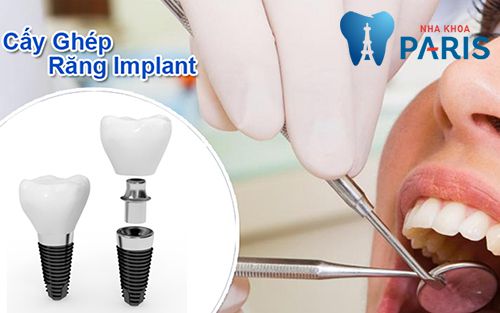Trồng răng implant giá bao nhiêu tiền? [Bảng Giá MỚI nhất 2019]