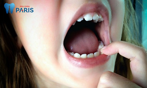 ” Hoang mang” Răng hàm lung lay có nên nhổ không ?
