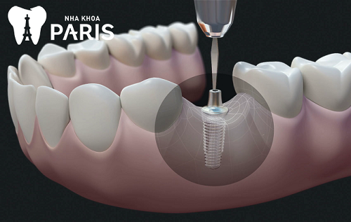 Trồng răng implant có đau không là thắc mắc của 90% người mất răng 