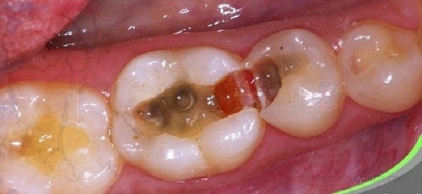 Băn khoăn: Răng hàm số 6 bị sâu có nên nhổ bỏ không?
