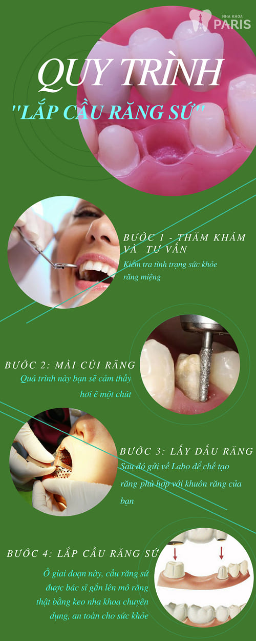Quy trình trồng răng sứ an toàn và bền đẹp