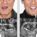 Răng implant có tốt không & quy trình thực hiện ra sao ?