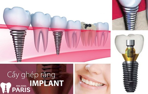 Răng chết tủy có nên nhổ không
