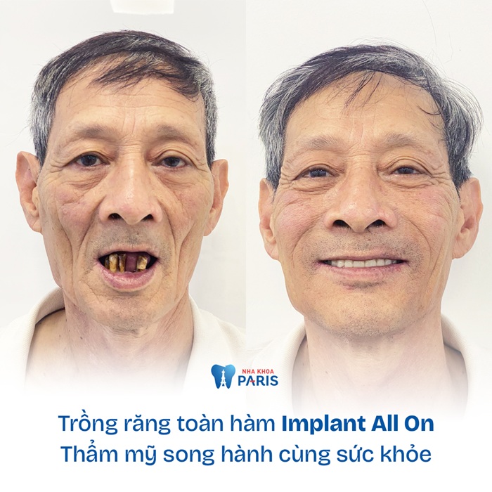 Hình ảnh khách hàng trồng răng tại Paris